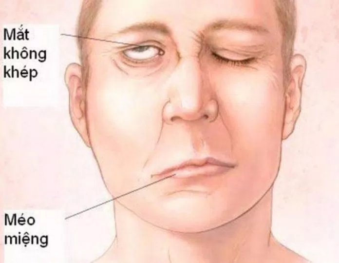 Khuôn mặt của người bị đột quỵ có sự bất đối xứng hai bên (Ảnh: Internet).
