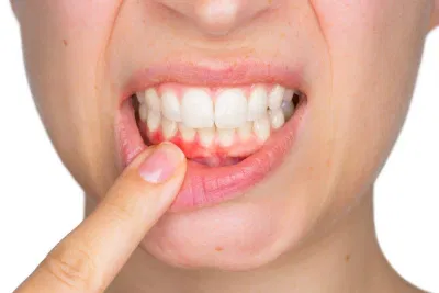 Có nhiều phương pháp khác nhau để điều trị bệnh nha chu, tùy mức độ viêm nhiễm (Nguồn: Internet). Có nhiều phương pháp khác nhau để điều trị bệnh nha chu, tùy mức độ viêm nhiễm (Nguồn: Internet).