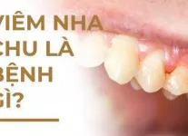 87 Top 5 cách trị rôm sảy cho bé yêu bằng thảo dược dễ tìm nhất mới nhất 2 viem nha chu cover