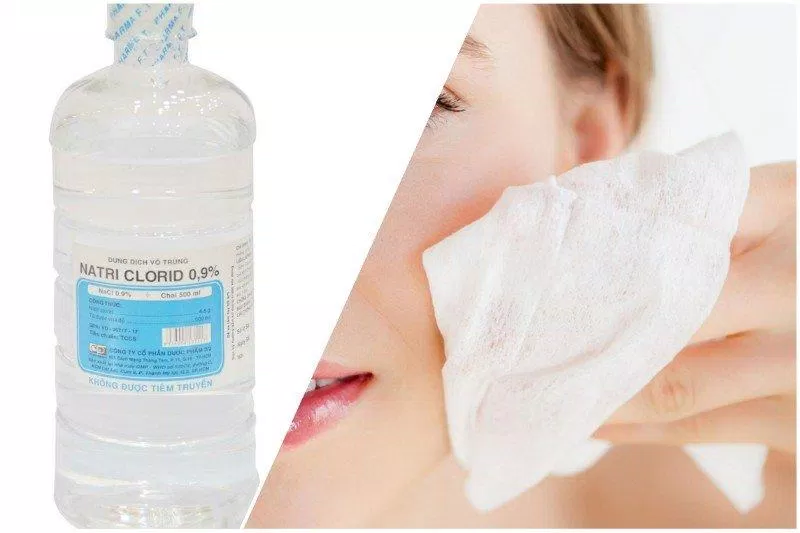 Làm sạch da bằng nước muối sinh lý (Nguồn: Internet) Làm sạch da bằng nước muối sinh lý (Nguồn: Internet)