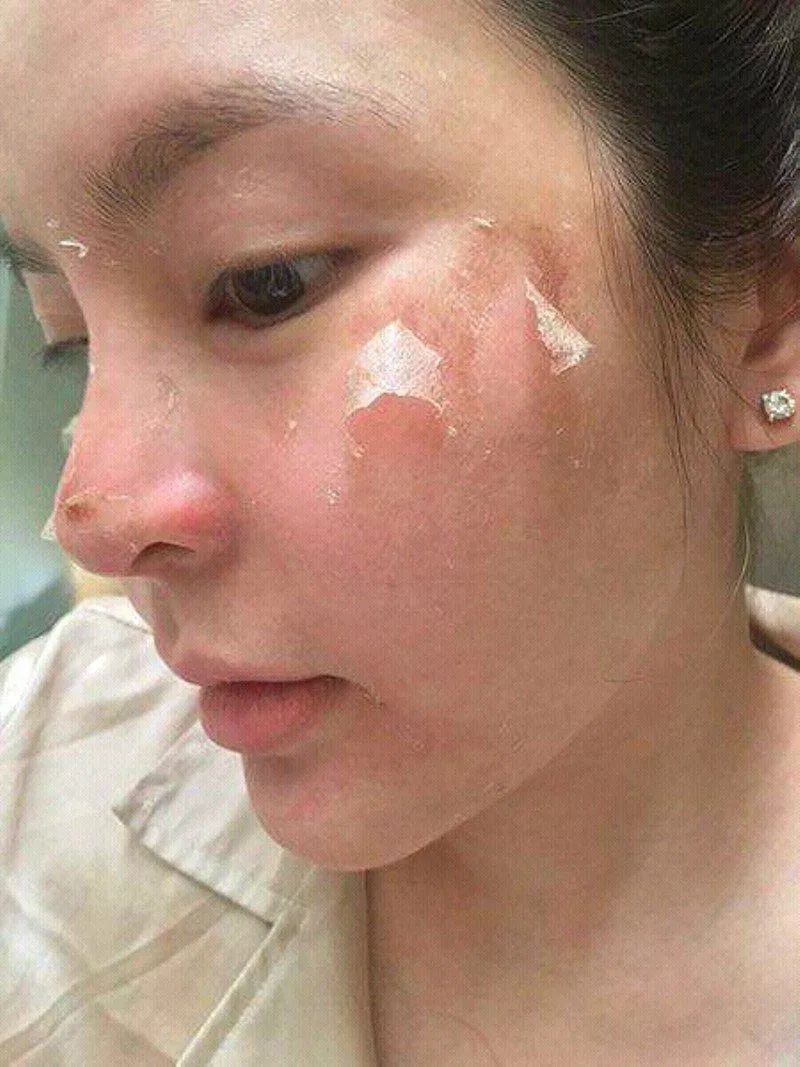 Peel trung se tác động sâu hơn (Nguồn: Internet) Peel trung se tác động sâu hơn (Nguồn: Internet)