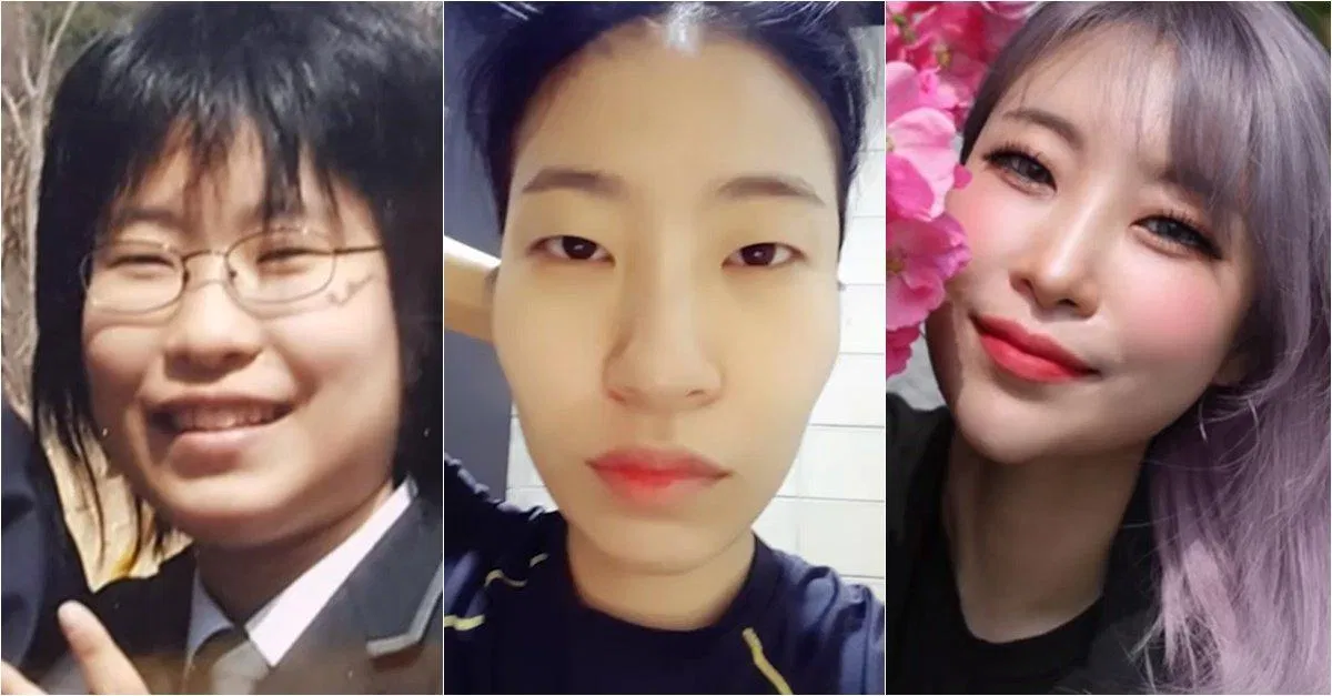 Sự thay đổi nhờ phẫu thuật thẩm mỹ của diễn viên hài Lee Se Young (Ảnh: Internet)