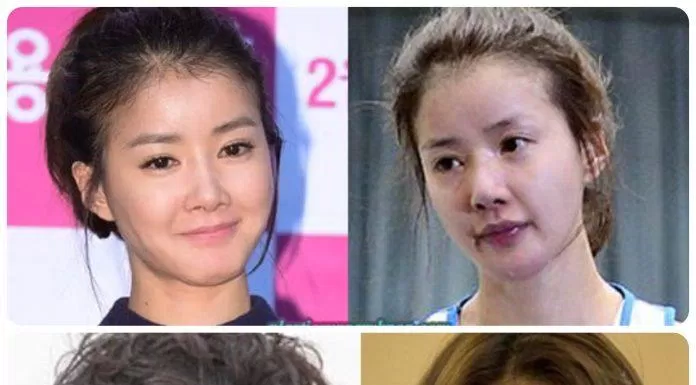 Những thay đổi của Lee Si Young nhờ phẫu thuật thẩm mỹ (Ảnh: Internet)