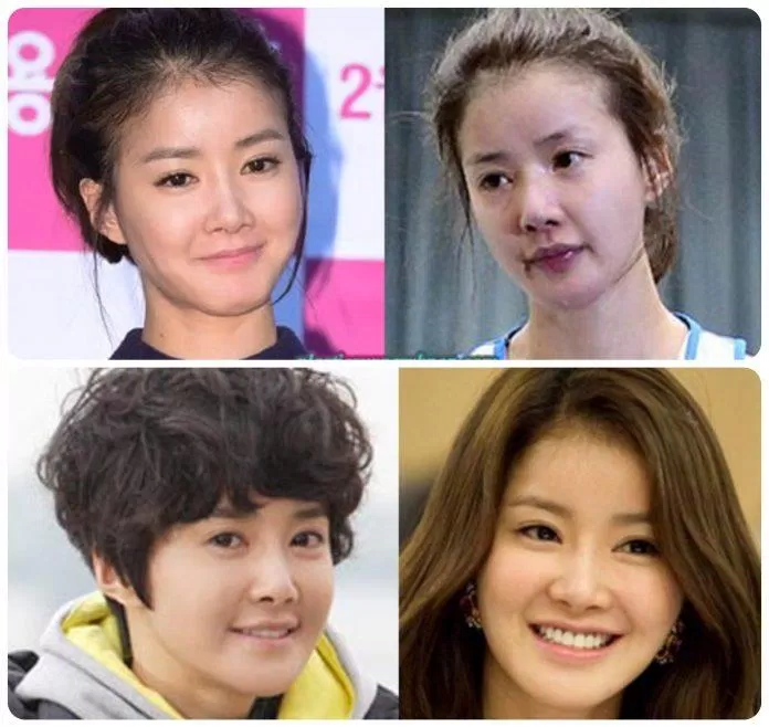 Những thay đổi của Lee Si Young nhờ phẫu thuật thẩm mỹ (Ảnh: Internet)