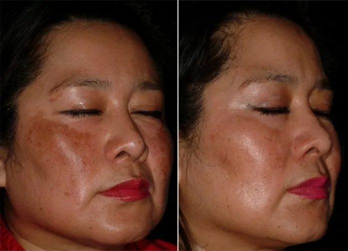 Thường xuyên sử dụng niacinamide có thể giúp làm giảm sắc tố da. (Nguồn: Internet).