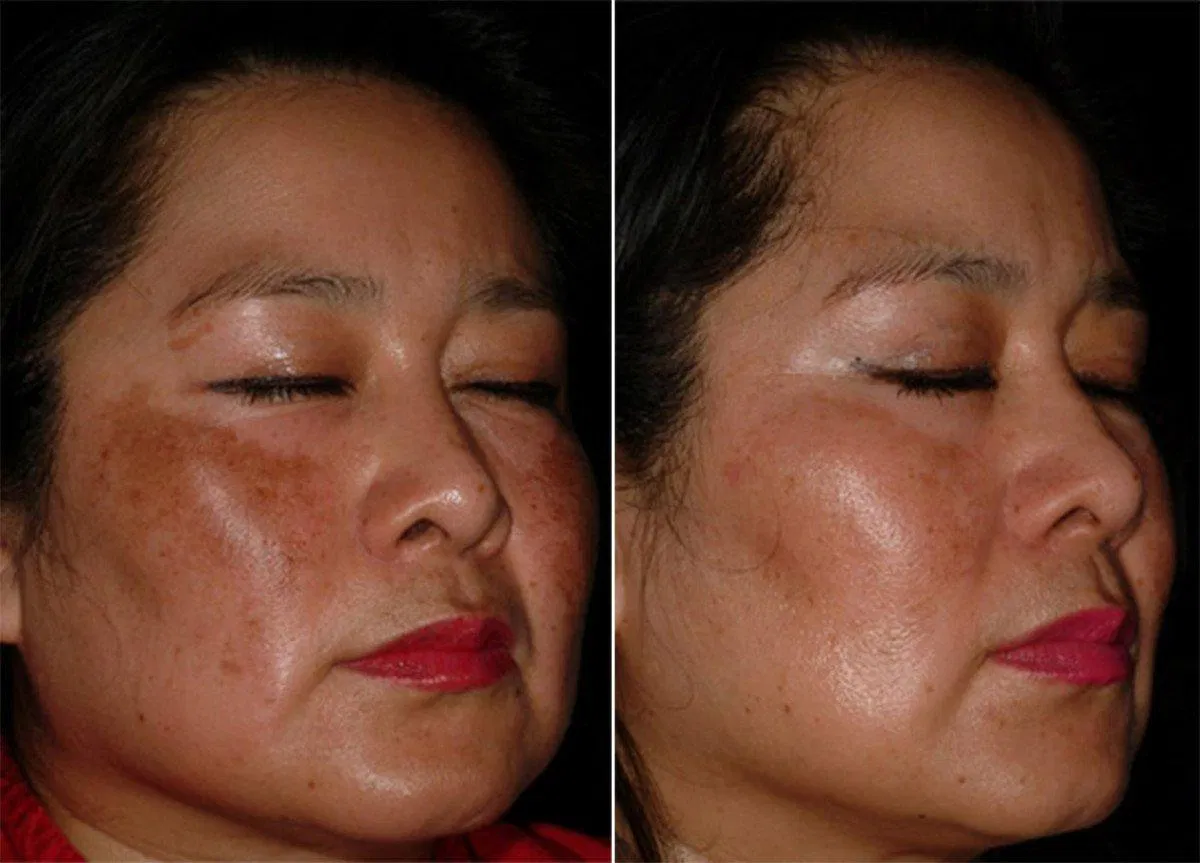 Thường xuyên sử dụng niacinamide có thể giúp làm giảm sắc tố da. (Nguồn: Internet).