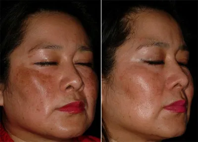 Thường xuyên sử dụng niacinamide có thể giúp làm giảm sắc tố da. (Nguồn: Internet).