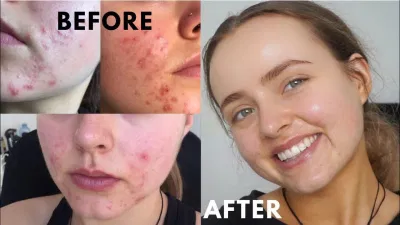 Thành quả sau một quá trình kiên trì sử dụng noacinamide của cô gái. (Nguồn: Internet),.