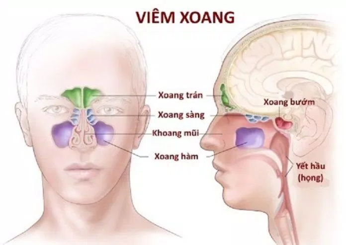 Các xoang của vùng mặt đều thông với mũi nên dễ bị viêm xoang do vi khuẩn từ mũi xâm nhập vào (Ảnh: Internet). Các xoang của vùng mặt đều thông với mũi nên dễ bị viêm xoang do vi khuẩn từ mũi xâm nhập vào (Ảnh: Internet).