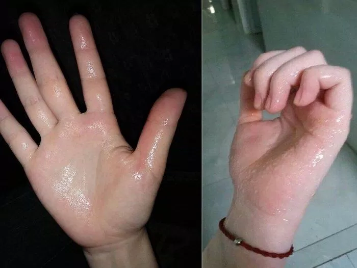 Ra mồ hôi tay chân gây khó chịu cho con người trong các hoạt động thường nhật. (Ảnh: Internet)