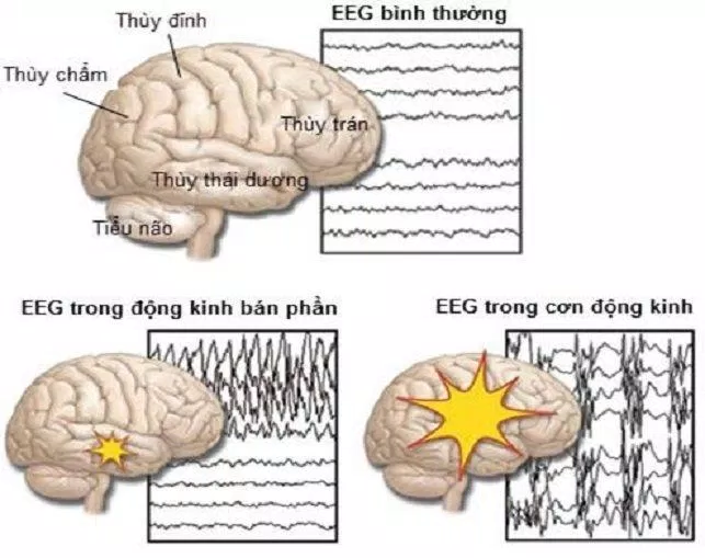 Sóng điện não trong cơn động kinh có khác biệt so với lúc bình thường (Ảnh: Internet).