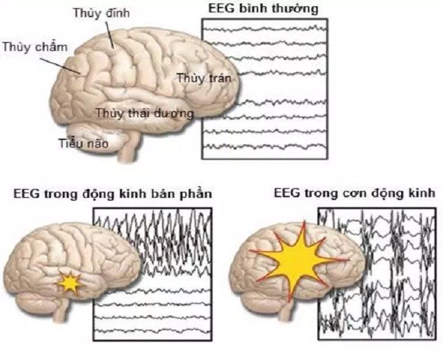 Sóng điện não trong cơn động kinh có khác biệt so với lúc bình thường (Ảnh: Internet). Sóng điện não trong cơn động kinh có khác biệt so với lúc bình thường (Ảnh: Internet).