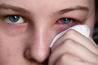 Hãy cẩn thận với các bệnh về mắt, chúng có thể lấy đi đôi "cửa sổ tâm hồn" của bạn đấy (Ảnh: Internet). Hãy cẩn thận với các bệnh về mắt, chúng có thể lấy đi đôi "cửa sổ tâm hồn" của bạn đấy (Ảnh: Internet).