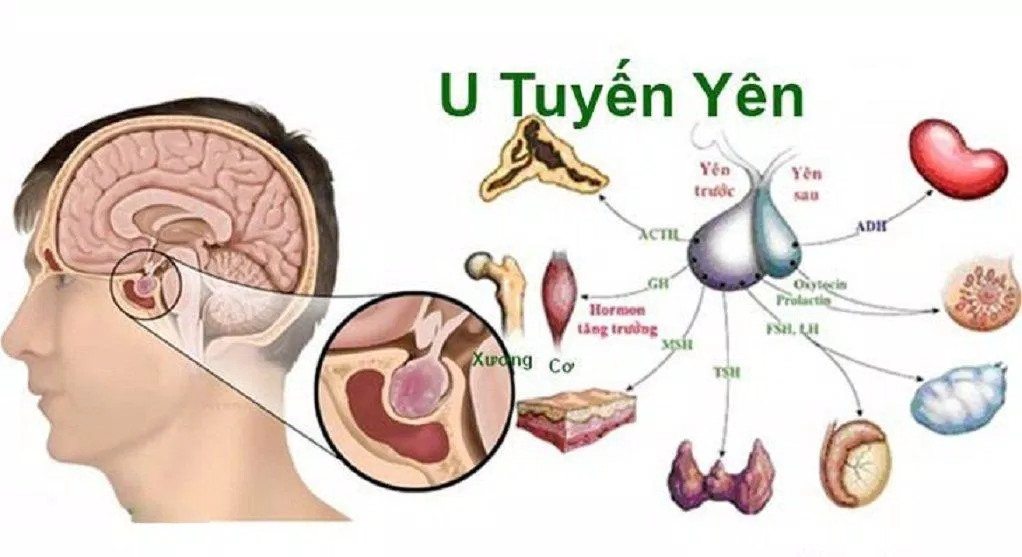 Khối u làm tuyến yên tăng tiết hormone có thể gây dậy thì sớm (Ảnh: Internet). Khối u làm tuyến yên tăng tiết hormone có thể gây dậy thì sớm (Ảnh: Internet).