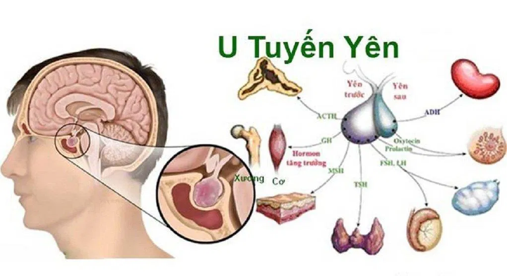 Khối u làm tuyến yên tăng tiết hormone có thể gây dậy thì sớm (Ảnh: Internet). Khối u làm tuyến yên tăng tiết hormone có thể gây dậy thì sớm (Ảnh: Internet).