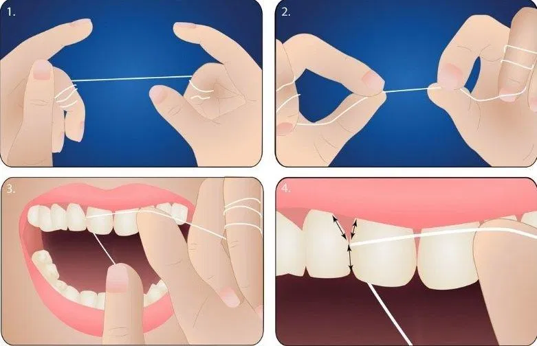 Dùng chỉ nha là phương pháp làm sạch kẽ răng hiệu quả (Nguồn: Internet) Dùng chỉ nha là phương pháp làm sạch kẽ răng hiệu quả (Nguồn: Internet)