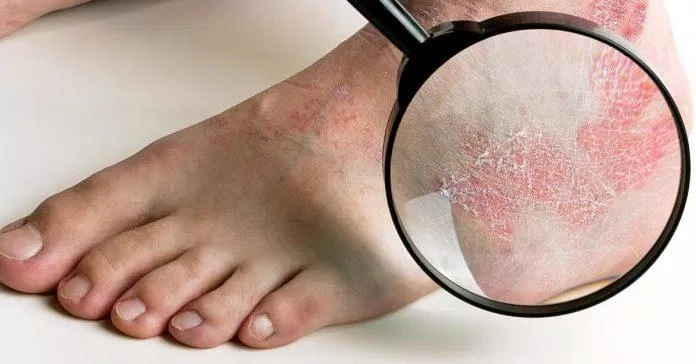 Vệ sinh chân sạch sẽ để phòng ngừa nấm. (Ảnh: Internet)