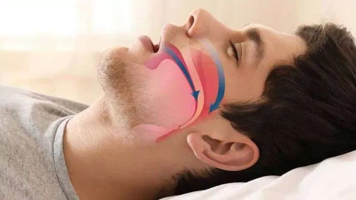 Thở bằng miệng khi ngủ dẫn đến hội chứng ngưng thở khi ngủ. (Nguồn: Internet)