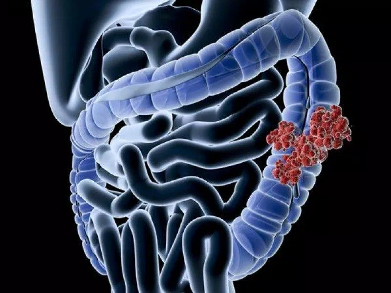 Bệnh Crohn gây viêm và tổn thương niêm mạc đường tiêu hóa nặng nề (Ảnh: Internet). Bệnh Crohn gây viêm và tổn thương niêm mạc đường tiêu hóa nặng nề (Ảnh: Internet).