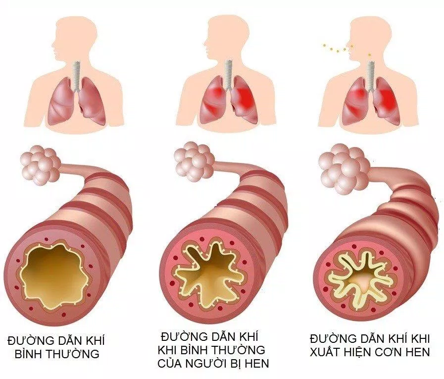 Đường dẫn khí bị hẹp lại ở bệnh nhân hen (Ảnh: Internet).