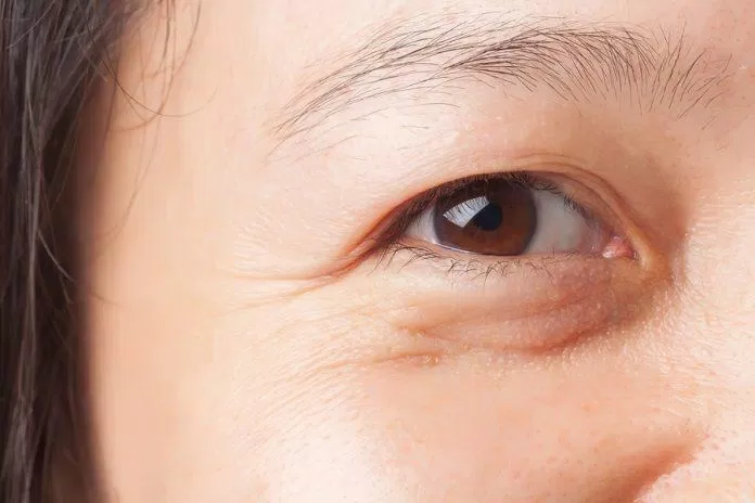 Bọng mắt thường xuất hiện ở những người lớn tuổi do quá trình lão hóa (Ảnh: Internet).