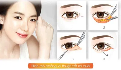 Phẫu thuật lấy mỡ bọng mắt là phương pháp đem lại hiệu quả lâu dài (Ảnh: Internet). Phẫu thuật lấy mỡ bọng mắt là phương pháp đem lại hiệu quả lâu dài (Ảnh: Internet).