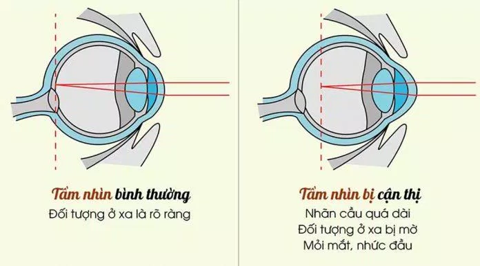 Sự khác biệt giữa mắt cận thị và mắt bình thường (Ảnh: Internet).