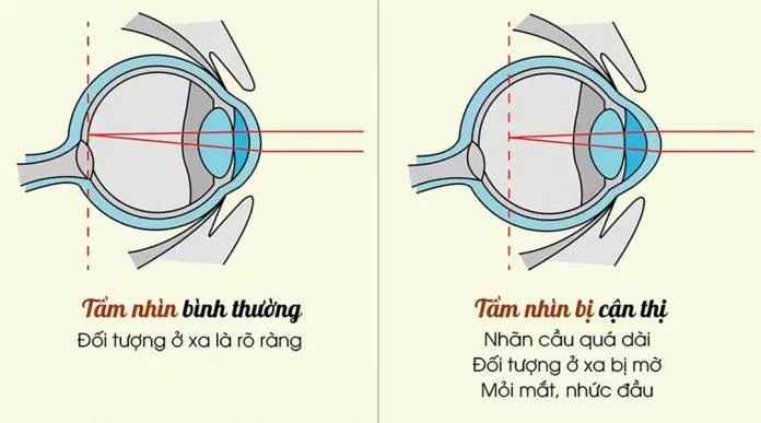 Sự khác biệt giữa mắt cận thị và mắt bình thường (Ảnh: Internet). Sự khác biệt giữa mắt cận thị và mắt bình thường (Ảnh: Internet).