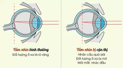 Sự khác biệt giữa mắt cận thị và mắt bình thường (Ảnh: Internet).