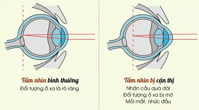 Sự khác biệt giữa mắt cận thị và mắt bình thường (Ảnh: Internet). Sự khác biệt giữa mắt cận thị và mắt bình thường (Ảnh: Internet).