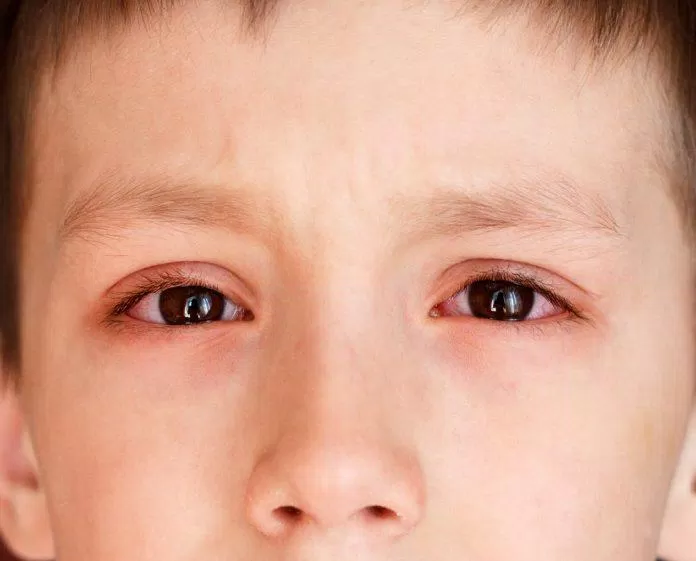 Mắt bị đỏ hoặc sưng là dấu hiệu cảnh báo bạn nên đến khám tại cơ sở y tế (Ảnh: Internet).