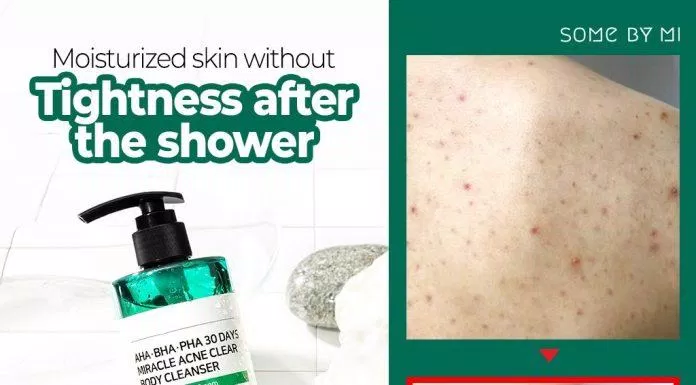Sữa tắm Some By Mi Miracle Acne Clear Body Cleanser có tác dụng điều trị mụn lưng chỉ sau 30 ngày sử dụng ( Nguồn: internet)