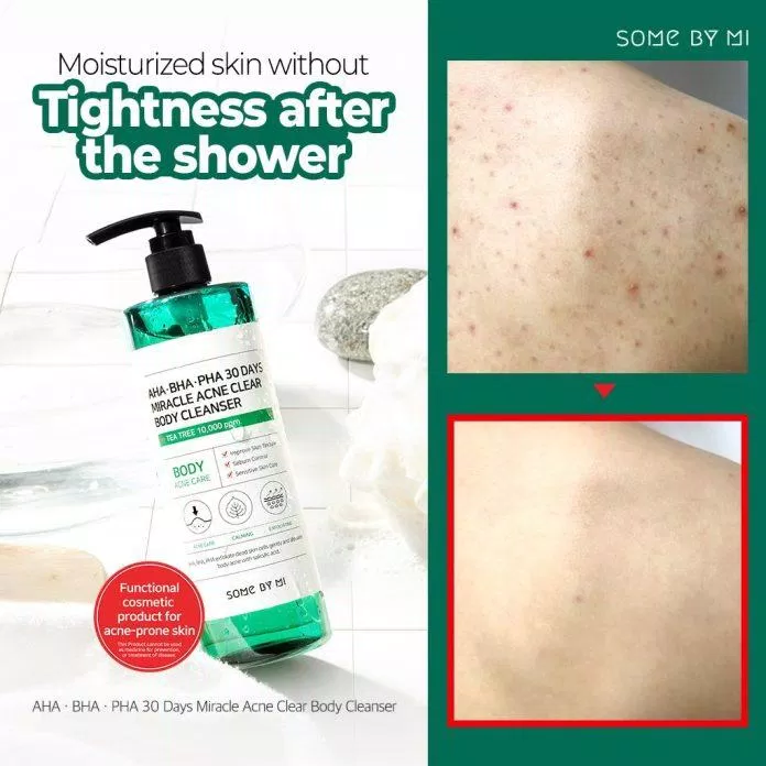Sữa tắm Some By Mi Miracle Acne Clear Body Cleanser có tác dụng điều trị mụn lưng chỉ sau 30 ngày sử dụng ( Nguồn: internet)