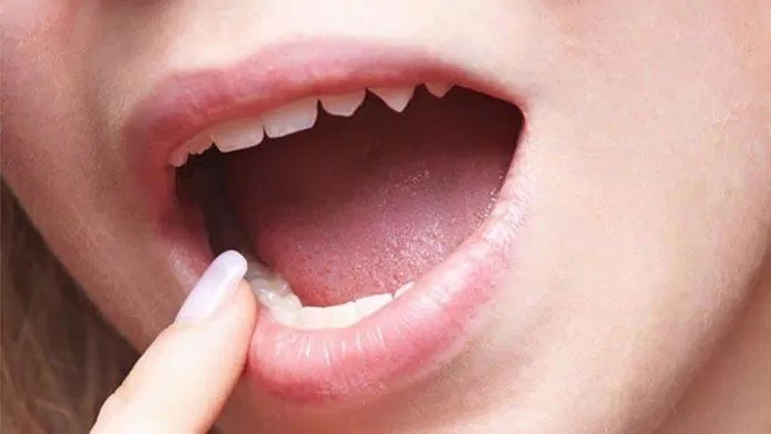 Thiếu sắt có thể khiến lưỡi sưng và nhợt nhạt hơn. (Nguồn: Internet)