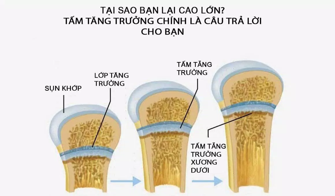 Tấm sụn tăng trưởng là nhân tố giúp kéo dài xương (Ảnh: Internet).