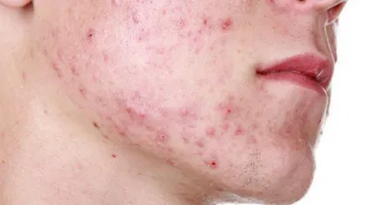Mụn trứng cá là một trong những tác dụng phụ gây mất thẩm mỹ cho người sử dụng thuốc steroid (Ảnh: Internet). Mụn trứng cá là một trong những tác dụng phụ gây mất thẩm mỹ cho người sử dụng thuốc steroid (Ảnh: Internet).