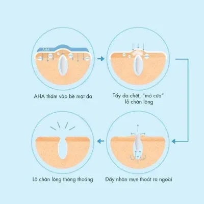 AHA có khả năng tẩy tế bào chết và hỗ trợ điều trị mụn trên da ( Nguồn: internet)