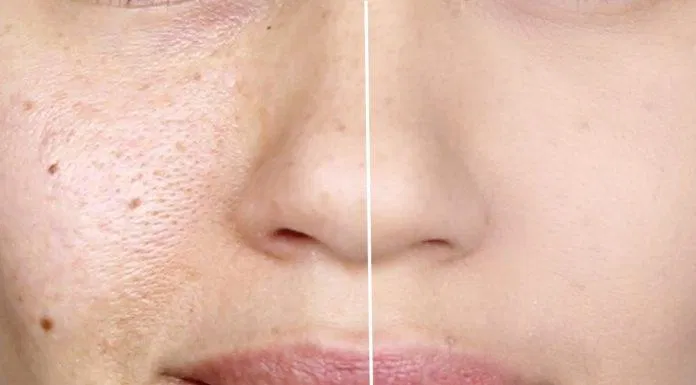 Lỗ chân lông là nơi chứa các nang lông và sợi bã nhờn được tạo ra bởi các tuyến bã nhờn (Nguồn: Internet).