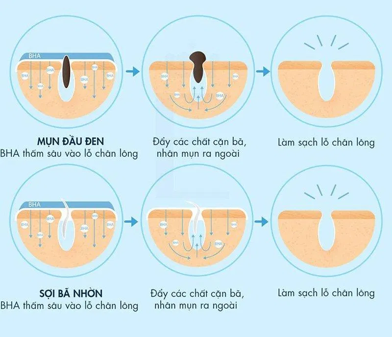 Nhờ khả năng tan tốt trong dầu nên BHA có khả năng làm sạch lỗ chân lông, loại bỏ bụi bẩn hiệu quả ( Nguồn: internet) Nhờ khả năng tan tốt trong dầu nên BHA có khả năng làm sạch lỗ chân lông, loại bỏ bụi bẩn hiệu quả ( Nguồn: internet)