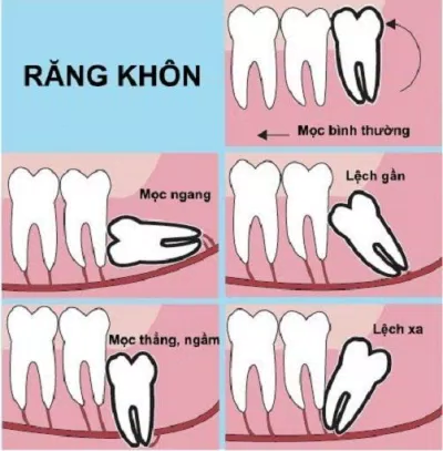 Răng khôn có thể mọc lệch theo nhiều hướng khác nhau (Ảnh: Internet).