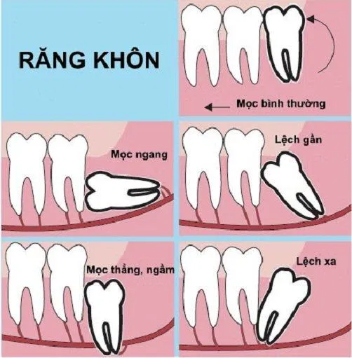Răng khôn có thể mọc lệch theo nhiều hướng khác nhau (Ảnh: Internet). Răng khôn có thể mọc lệch theo nhiều hướng khác nhau (Ảnh: Internet).
