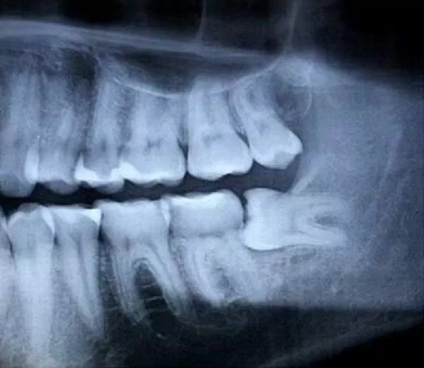 Phim chụp X quang cho thấy răng khôn mọc ngang (Ảnh: Internet).