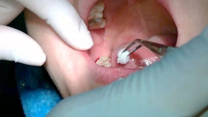 Nhổ răng khôn có thể thực hiện kể cả khi chưa có dấu hiệu bất thường (Ảnh: Internet).
