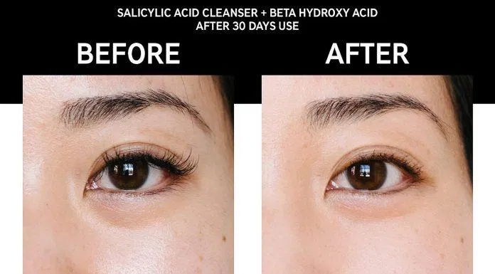 Sữa rửa mặt trị mụn The Inkey List Salicylic Acid Cleanser có khả năng giảm mụn hiệu quả (Nguồn: Internet)