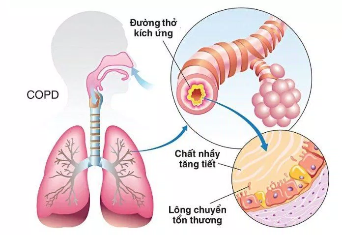 Đường thở bị kích ứng và tăng tiết nhầy trong bệnh COPD (Ảnh: Internet).