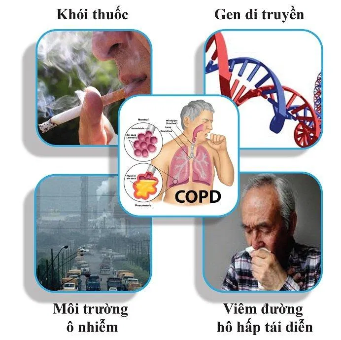 Nhiều yếu tố khác có thể làm tăng nguy cơ mắc COPD (Ảnh: Internet). Nhiều yếu tố khác có thể làm tăng nguy cơ mắc COPD (Ảnh: Internet).