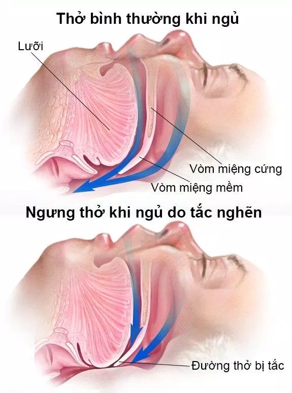 Đường thở bị tắc nghẽn gây ngưng thở khi ngủ (Ảnh: Internet). Đường thở bị tắc nghẽn gây ngưng thở khi ngủ (Ảnh: Internet).