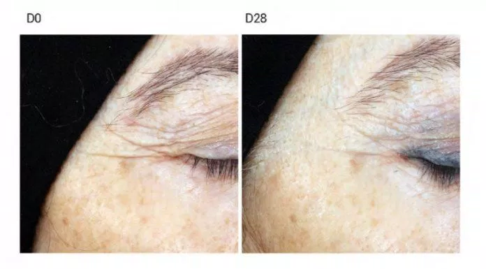 Hình ảnh trước và sau: tăng sinh collagen loại IV đến 130%, kết quả sau 28 ngày làm mờ vết chân chim đuôi mắt.