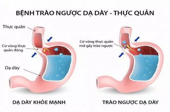 Thức ăn trong dạ dày bị trào ngược lên thực quản (Ảnh: Internet). Thức ăn trong dạ dày bị trào ngược lên thực quản (Ảnh: Internet).