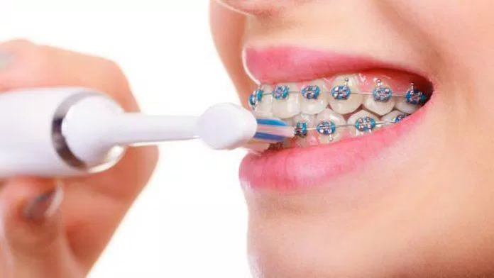 Bàn chải điện rất phù hợp với những người đeo niềng răng (Ảnh: Internet). Bàn chải điện rất phù hợp với những người đeo niềng răng (Ảnh: Internet).